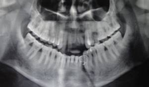 Перелом челюсти: последствия, со смещением, открытый