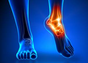 Перелом мизинца на ноге: симптомы, как определить