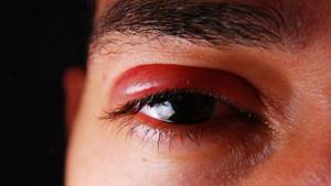 Травма глаза: лечение, в домашних условиях, капли, первая помощь
