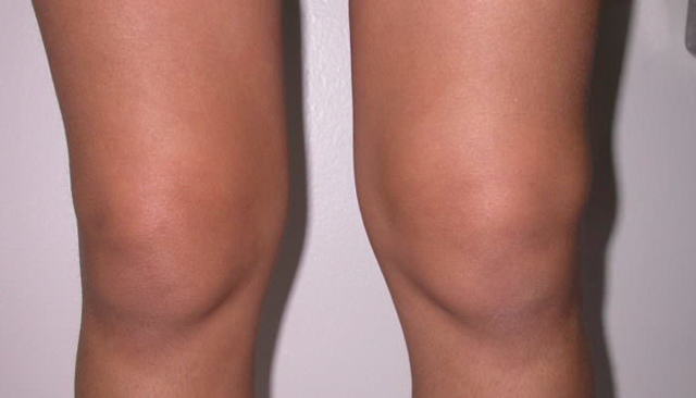 Болит колено при сгибании и разгибании: ходьбе, боли, как лечить