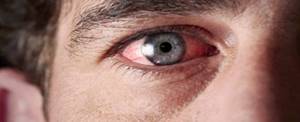 Болят глаза от сварки: что делать в домашних условиях, чем лечить