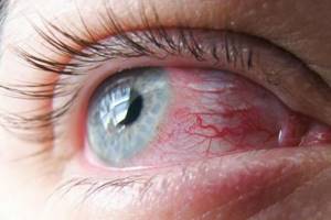 Болит глаз при моргании и надавливании: когда моргаю, больно