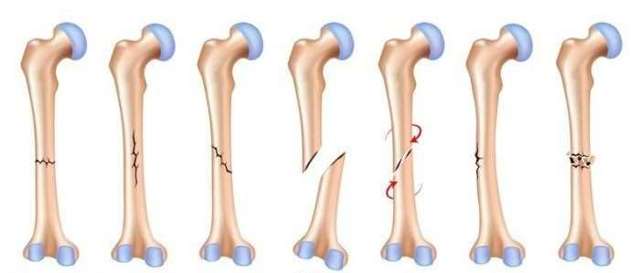 Перелом плечевой кости со смещением: лечение, операция