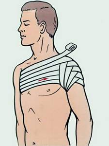 Повязка на плечевой сустав: фиксирующая на плечо