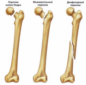 Закрытый перелом правой бедренной кости: со смещением, помощь