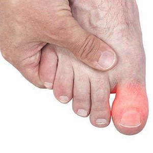 Перелом большого пальца ноги: симптомы, признаки, трещина