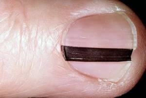 Синяк под ногтем большого пальца ноги: как лечить, избавиться
