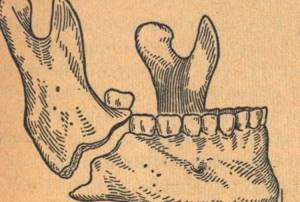Перелом нижней челюсти: лечение, классификация, виды