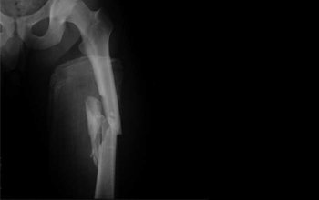 Перелом диафиза бедренной кости: диафизарный, лечение
