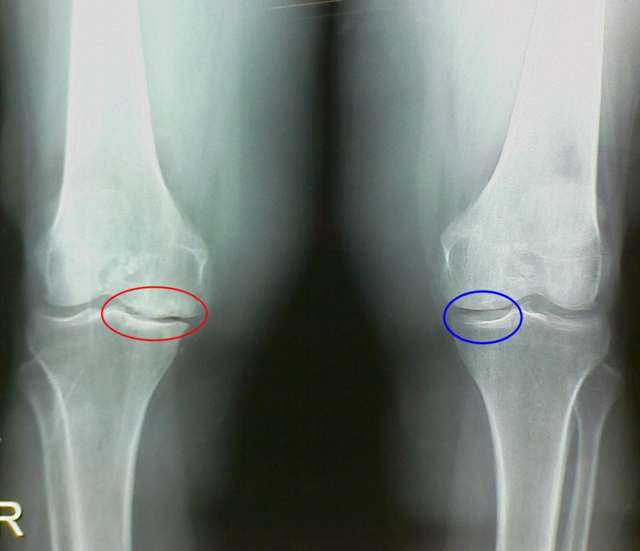 Хондропротекторы при артрозе коленного сустава: коксартрозе