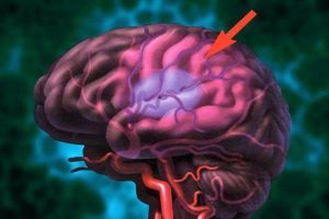 Гематома головного мозга: субдуральная, эпидуральная, симптомы
