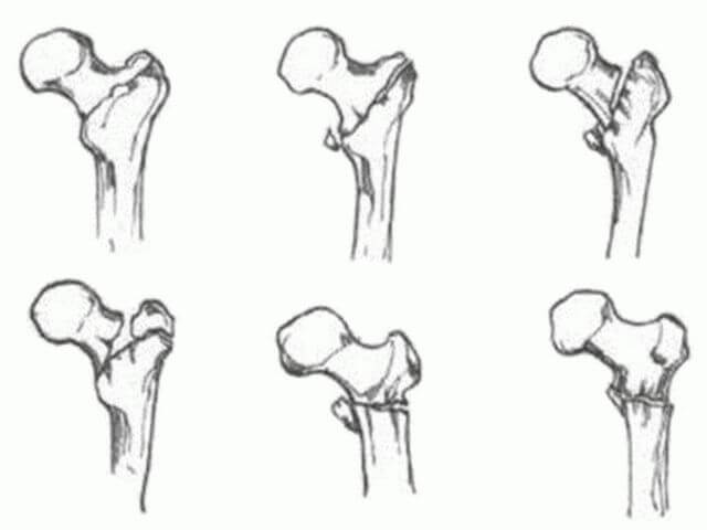 Чрезвертельный перелом бедренной кости: со смещением, лечение