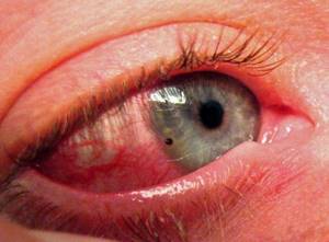 Повреждение роговицы глаза: лечение, последствия, отслоение