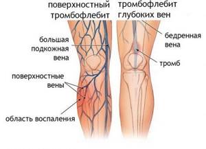 Немеет левая нога от колена до стопы: причины, почему онемела