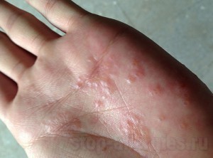 Аллергия на пальцах рук и пузырьки: лечение, чем лечить