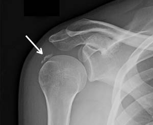 Перелом большого бугорка плечевой кости: без смещения, лечение