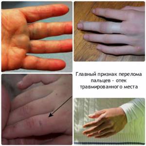 Ушиб пальца на руке: что делать, в домашних условиях