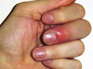 Как лечить ушиб пальца на руке: чем лечить, лечение