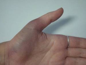 Ушиб большого пальца на руке: сустава, фаланги