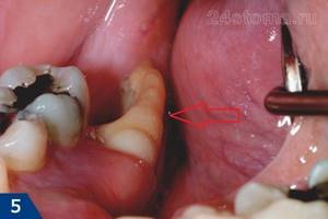 После удаления зуба болит десна: что делать, как долго, опухла