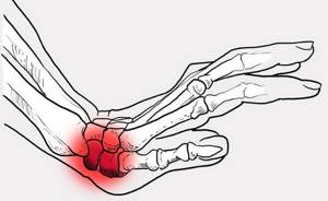Ушиб кисти руки при ударе: лечение в домашних условиях, симптомы