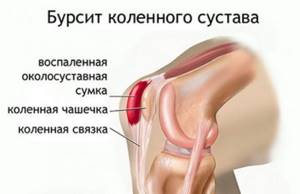 Ушиб колена при падении: лечение, в домашних условиях, что делать