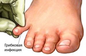 Опух палец на ноге без причины и болит: распух, что делать