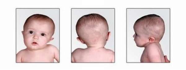 Подвывих шейного позвонка у ребенка: ротационный, новорожденных