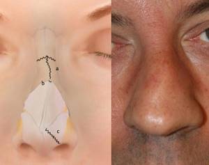 Перелом носа со смещением: лечение, костей