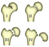 Перелом шейки бедренной кости: классификация, лечение