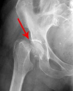 Перелом шейки бедренной кости: классификация, лечение