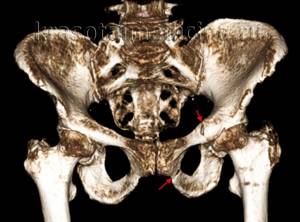 Перелом костей таза: первая помощь, признаки, классификация