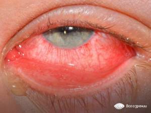 Болит правый глаз: внутри, резко заболел, причины
