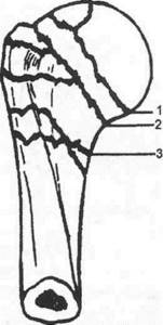 Вколоченный перелом плечевой кости: головки, хирургический шейки