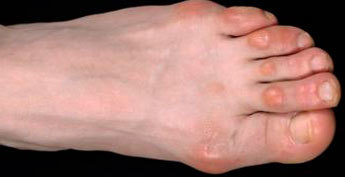Мозоль между пальцами на ноге болит со стержнем: лечение