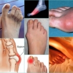 Болят суставы пальцев ног: средство от боли, от чего