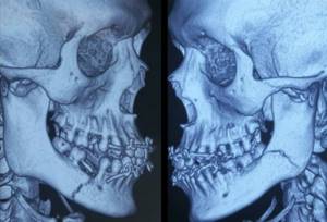 Перелом челюсти: сколько заживает, заживление, время, как долго