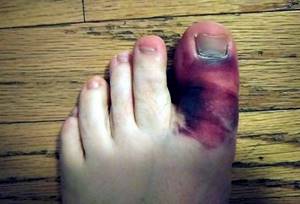 Перелом большого пальца ноги: симптомы, признаки, трещина