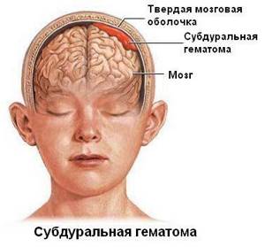 Гематома на голове: после ушиба, у новорожденных, лечение