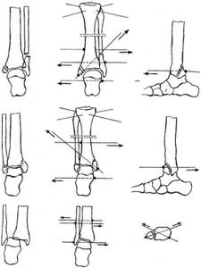 Удаление позиционного винта при переломе лодыжки: снятие