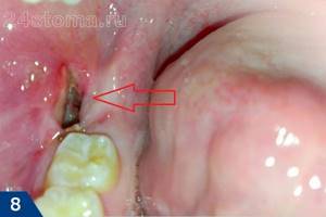 После удаления зуба болит десна: что делать, как долго, опухла