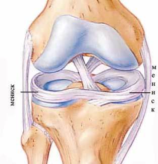 Разрыв мениска коленного сустава: лечение без операции, симптомы и операция