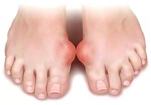 Болит сустав большого пальца на ноге: как лечить, лечение