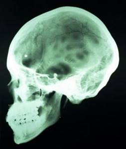 Открытая и закрытая черепно-мозговая травма: последствия