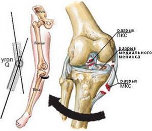 Разрыв крестообразной связки колена: лечение без операции