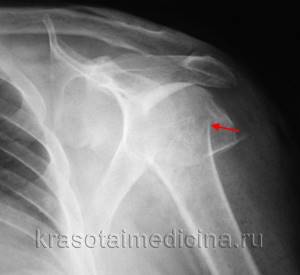 Перелом плечевой кости: иммобилизация, фиксация