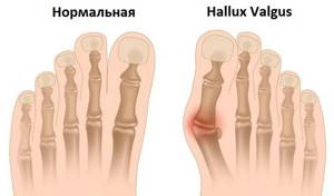 Болит шишка на ноге у большого пальца: что делать, чем лечить