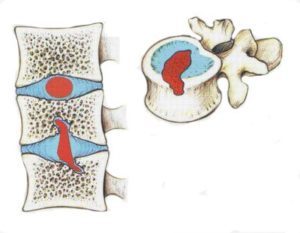 Грыжа грудного отдела позвоночника: симптомы и лечение, Шморля