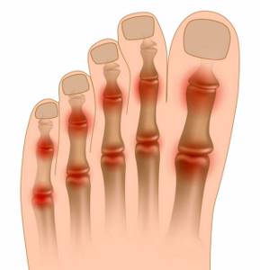 Болят суставы пальцев ног: средство от боли, от чего