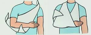 Ушиб плеча при падении: не поднимется рука, лечение в домашних условиях